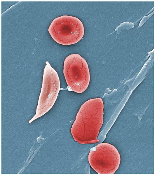 drepanocytose